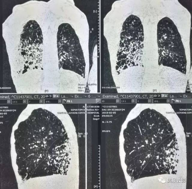 肺纤维化蜂窝肺图片