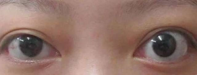 即角膜下缘的白色巩膜露出来了,如果白色巩膜暴露过多,会显得人很