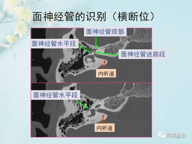 面神经管 断层图片