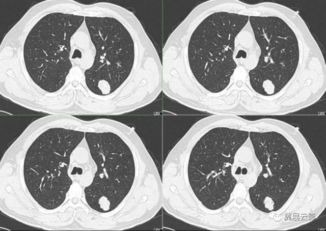 8种肺部良性肿瘤及肿瘤样病变