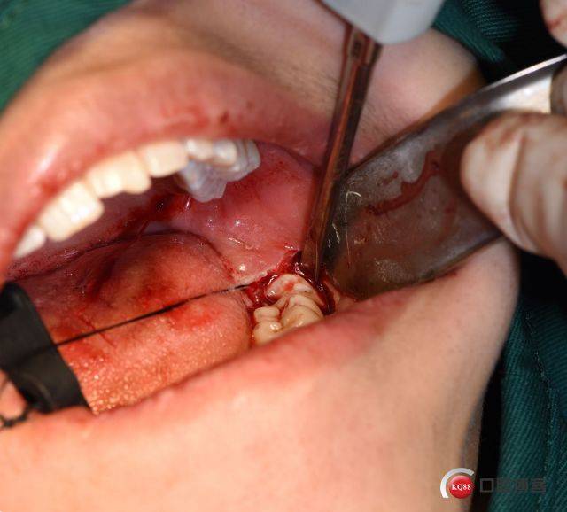 一次性微创拔除阻生智齿