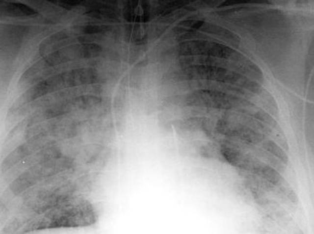 肺部阴影图片胸片图片