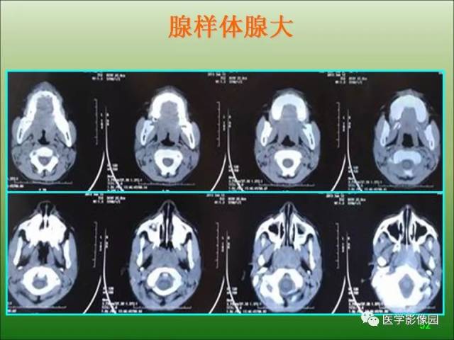 腺样体肥大ct图详解图片