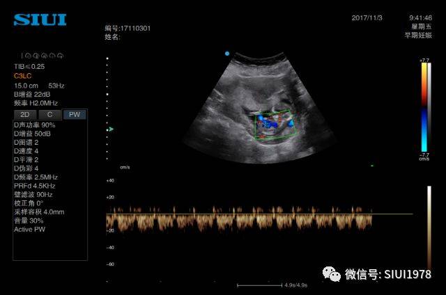 其频谱如下图所示:大多数胎儿在查nt的时候就可以观察到静脉导管了,我