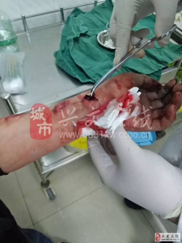 太吓人!宜宾14岁男孩双手被炸烂!春节期间这些一定要注意!