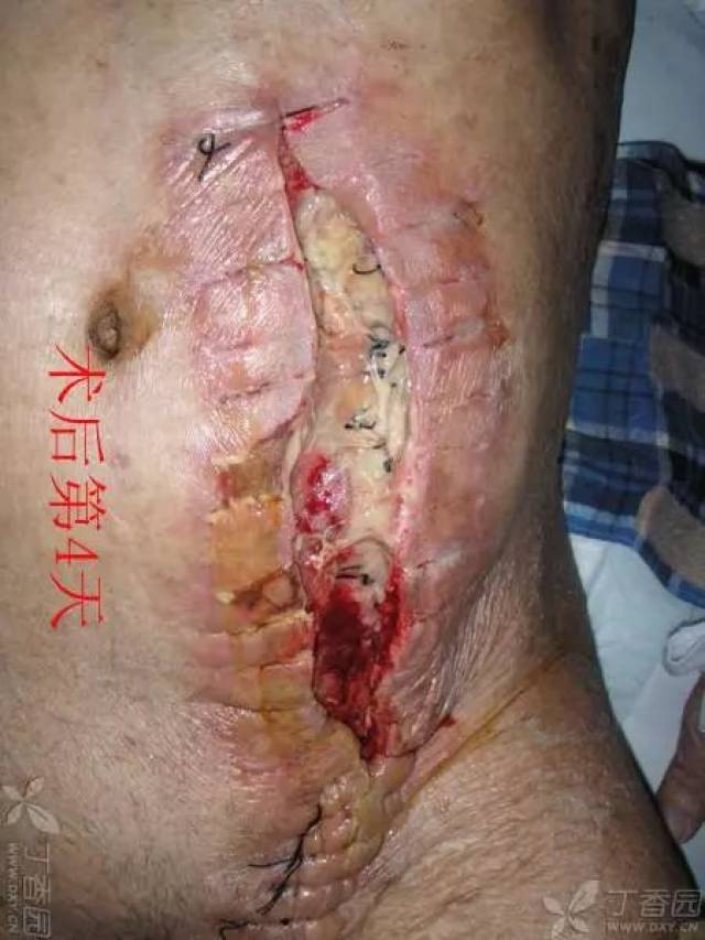 男性疝气手术疤痕图片图片