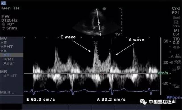 根据美国超声心动图学会/欧洲心血管影像协会测量左心室舒张功能流程