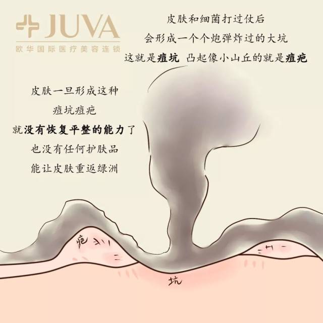 漫话医美:痘印、痘坑毁一生?真有那么恐怖?!