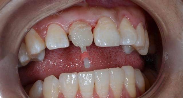 门牙牙髓炎图片