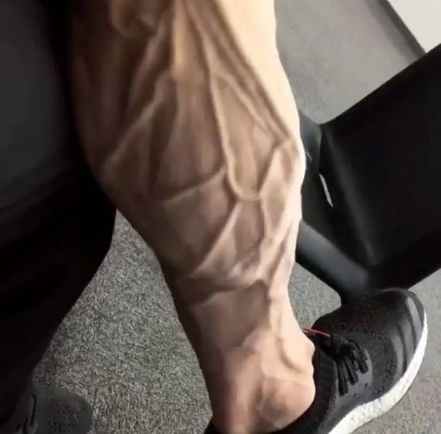 这位26岁的健美冠军小腿静脉爆裂,低体脂引发的悲剧!