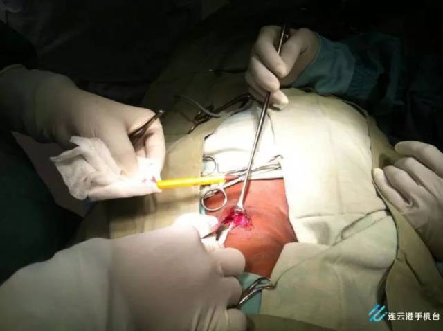当铅笔被取出时,手术室里响起了一片欢呼声.