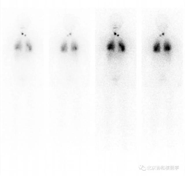 碘131全身显像正常图图片