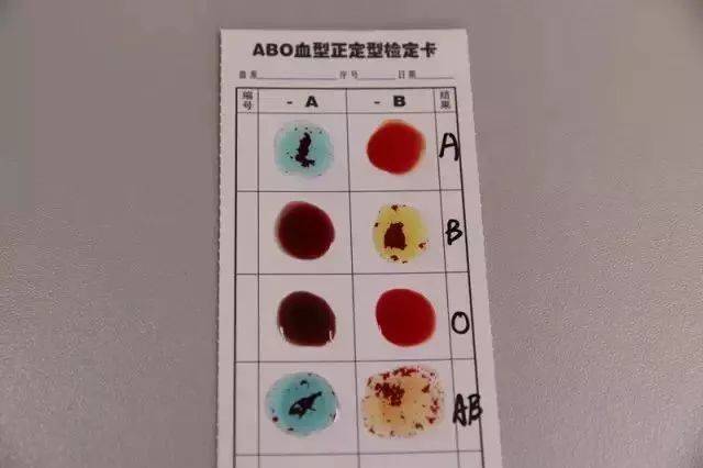 血型鉴定凝集反应图片图片