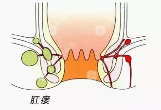 疖子和肛周脓肿区别图图片