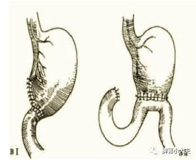 图文详解 胃癌3大类切除术及吻合手段选择