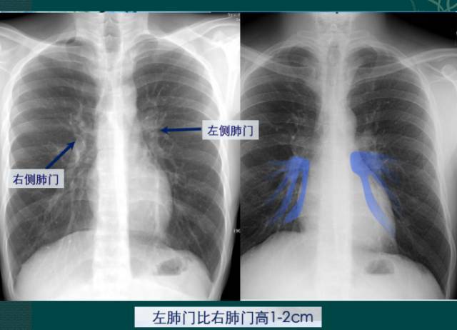 ct肺门位置图片