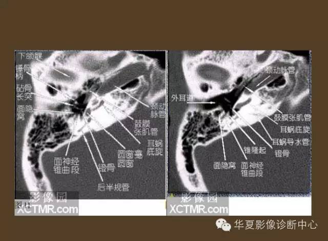 好详细的解剖 — 耳部hrct图像详解