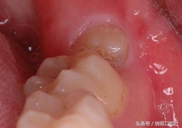 拍片检查牙槽骨是否骨折或者咬合错乱,拔牙一个半月后再做牙槽骨修整