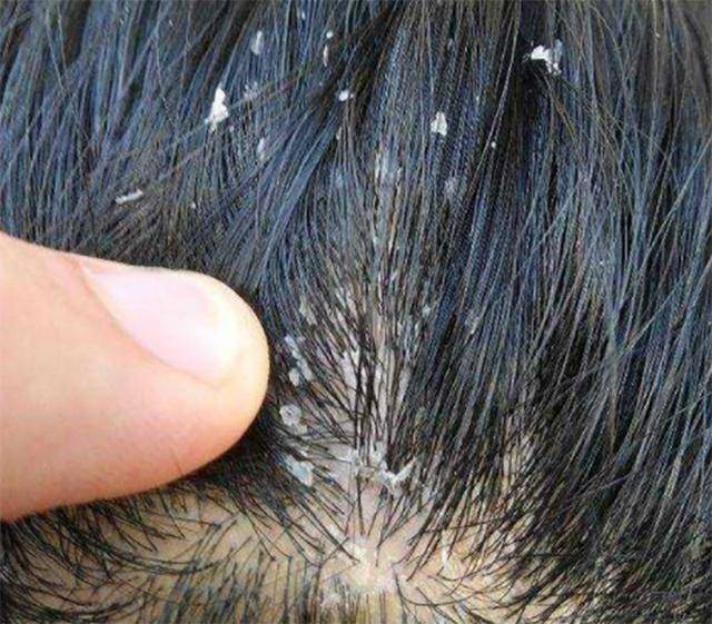 洗发水不如洗发精,2种表现可看出,头皮清爽少脱发主要是靠它!