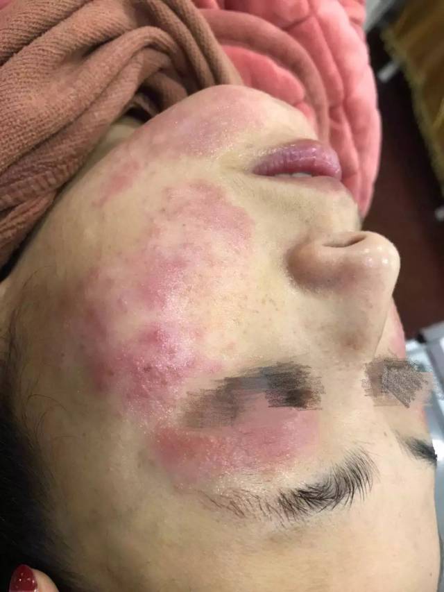 皮肤过敏,又红又痒,怎么办?