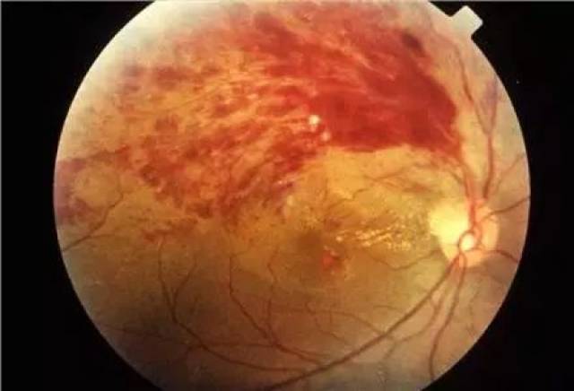 视网膜动分支动脉阻塞,视网膜分支静脉阻塞;高血压性视网膜病变;肾病