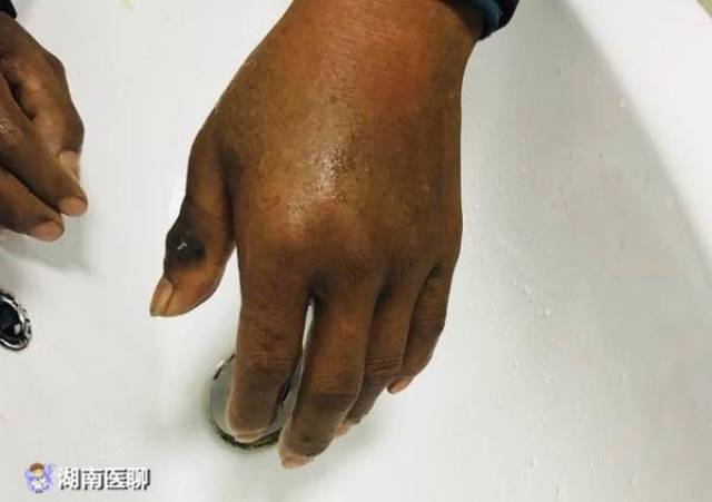 农夫被蛇咬一口,手指马上变黑!医生感叹幸亏来得早
