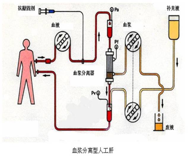 mars人工肝示意图图片