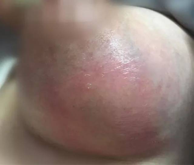 淤青破皮脓肿这是催乳还是毁乳