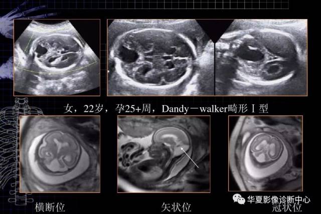 磁共振检查胎儿男女图图片