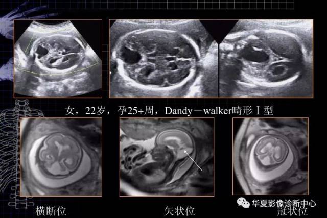 进一步了解 — mri胎儿颅脑检查的作用及临床意义