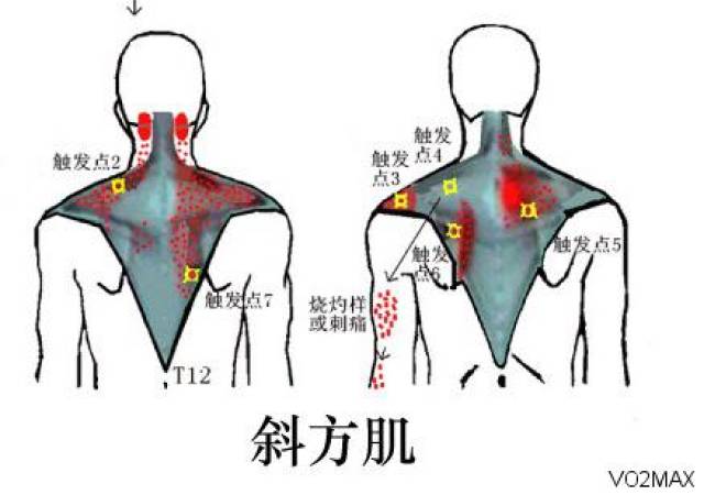 疼痛的元凶-肌肉劳损点和肌筋膜粘连点