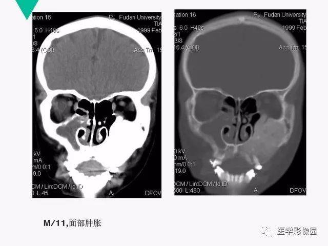 副鼻窦ct平扫图片图片