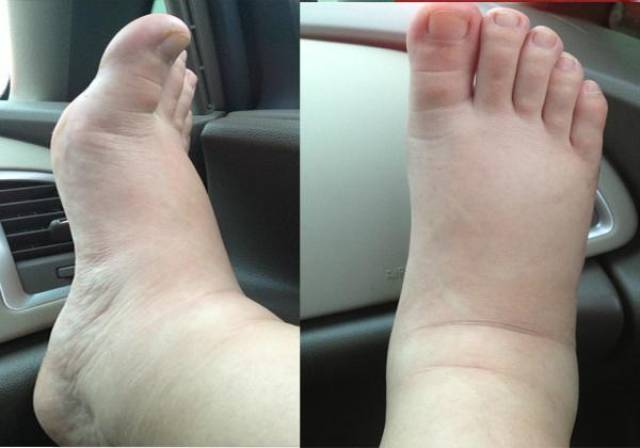 从怀孕后一直保持着不错的体型,也没发现有水肿现象,胖也只胖肚子