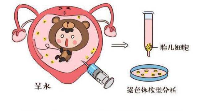 羊水穿刺给报销吗 杭州羊水穿刺进医保吗