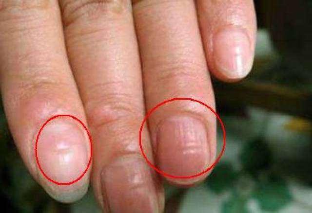 肝硬化指甲症状图片图片
