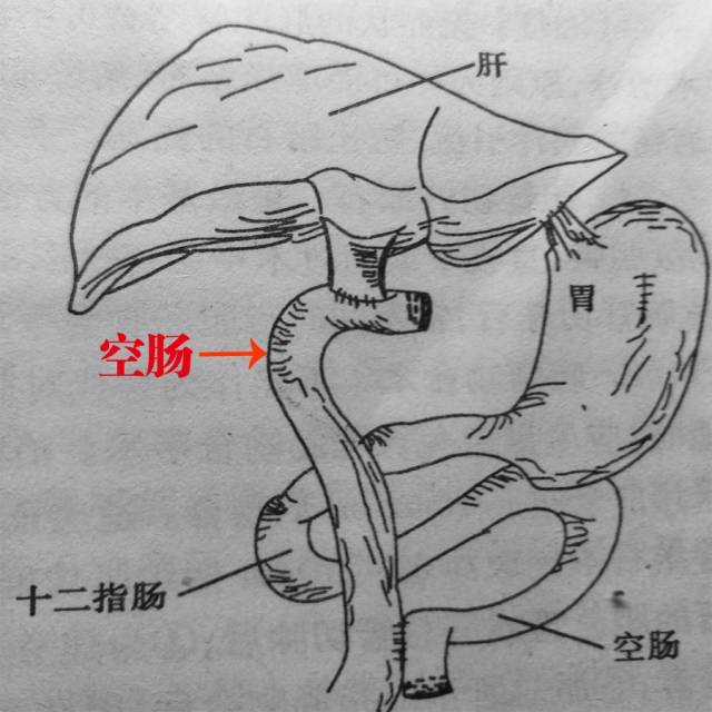 胆肠吻合术示意图图片