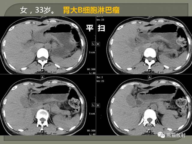 专题丨原发性胃肠道淋巴瘤的影像诊断及鉴别诊断