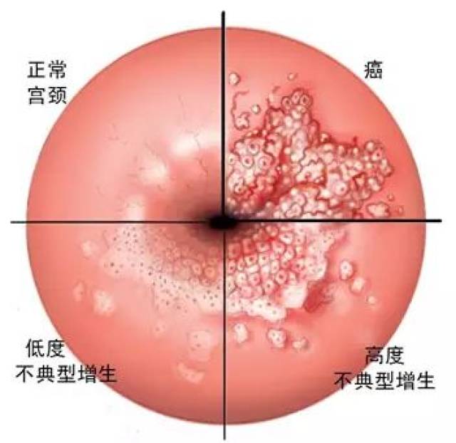 从正常到低度不典型增生,到高度不典型增生,最后发展为宫颈癌:宫颈癌