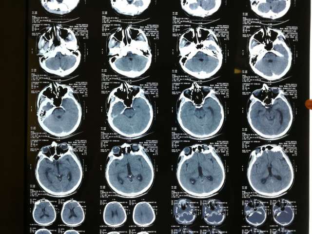 贺晓生教授谈手术 ——四脑室肿瘤手术切除