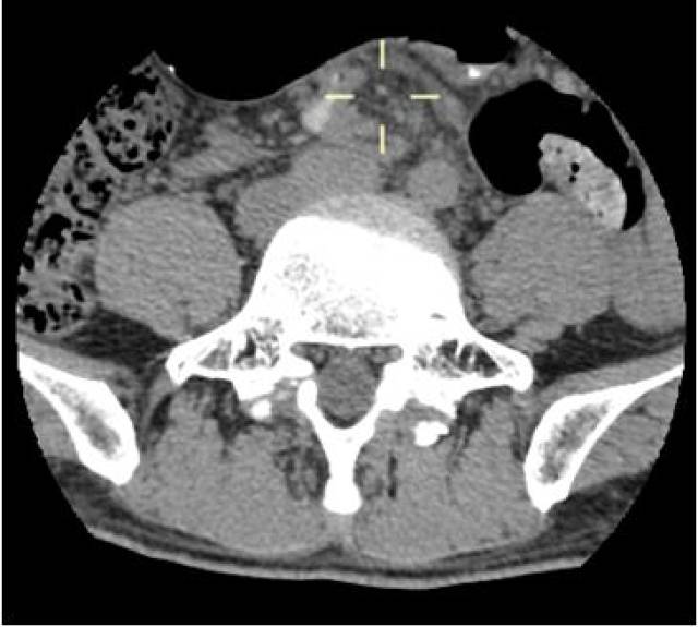 惊险!这个腰椎CT的大坑值得大家警惕!