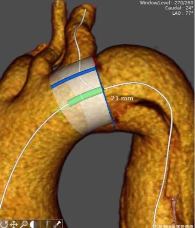 大动脉覆膜支架系统图片