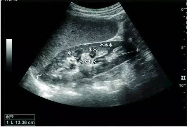 各類腎臟病超聲圖像表現