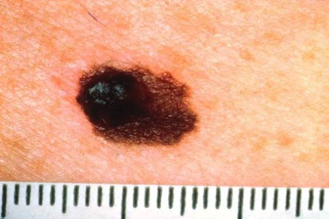 黑色素瘤初期自查图片