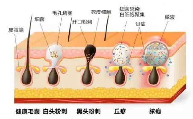 粉刺图片,各种痘痘类型图片,脸上螨虫图片(第2页)_文秘苑图库