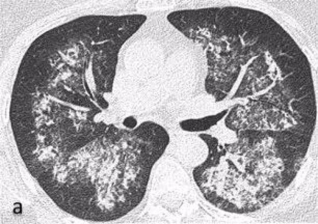 anca相关性血管炎 | "肺"常表现,非常多样