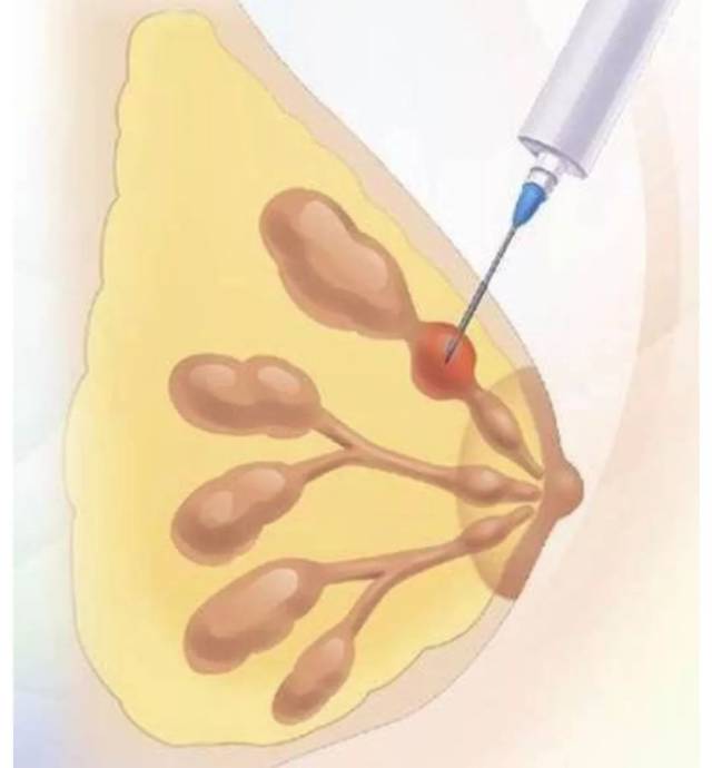 01  乳房穿刺针活检,是指用穿刺针或一般静脉穿刺针, 刺入乳房肿块内