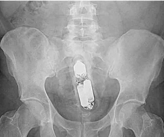 x光下的人体异物盘点好奇他们都是怎么进去的