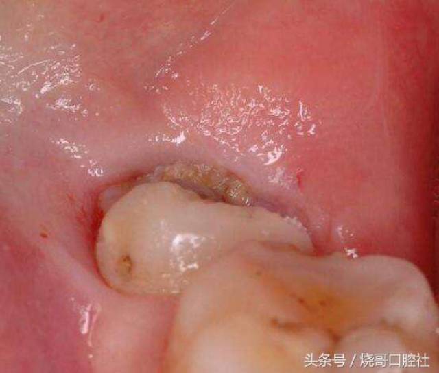 清洁牙齿,建议准备要孩子的准妈妈要提前做好口腔检查,如果有牙龈盲袋