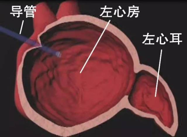 左心耳断层解剖图片