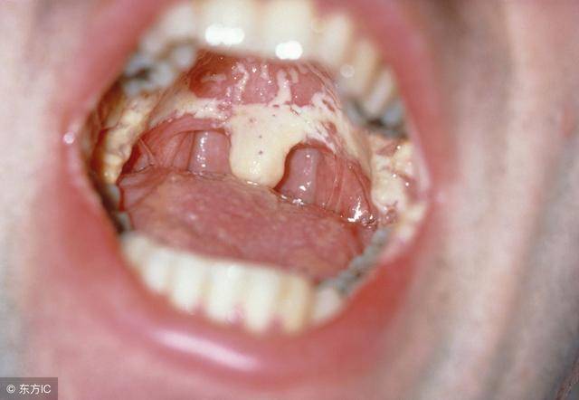 艾滋病早期牙龈图片图片